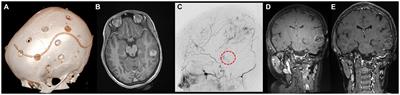 Laser interstitial thermal therapy is effective and safe for the treatment of brain tumors in NF1 patients after cerebral revascularization for moyamoya angiopathy: a report on two cases